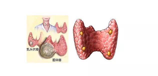 甲状腺补硒有什么好处