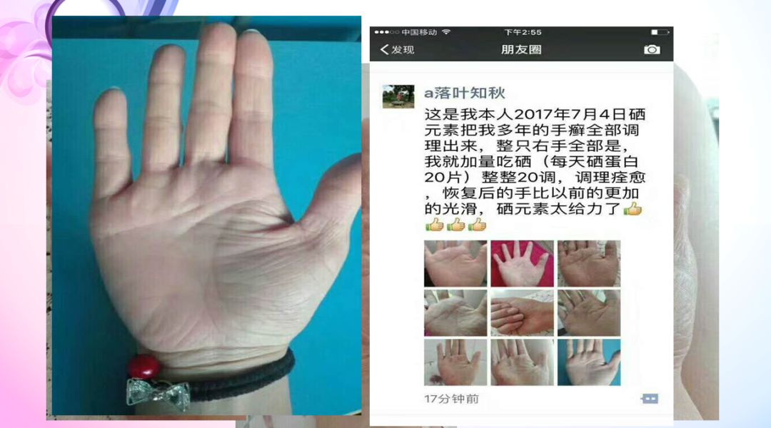 肝病患者补硒治愈视频