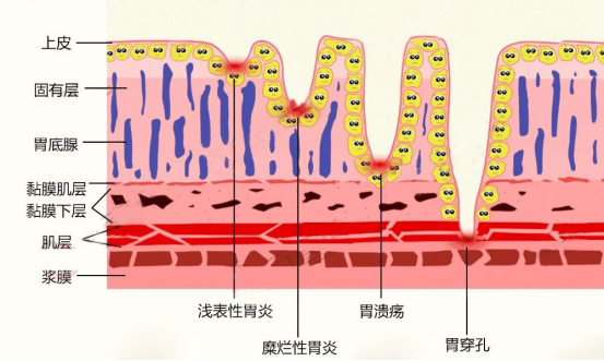 有胃糜烂病的怎样补硒