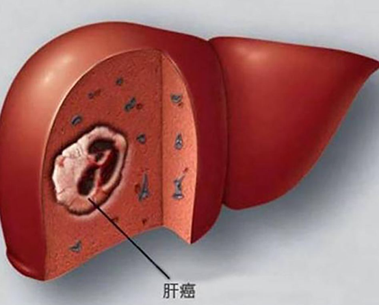 补麦芽硒抗癌成功案例