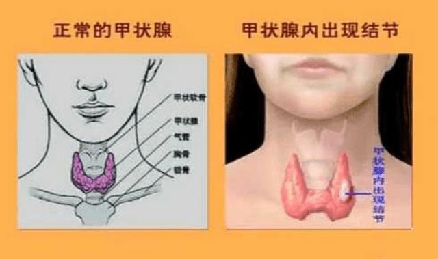 补硒预防甲状腺结节吗