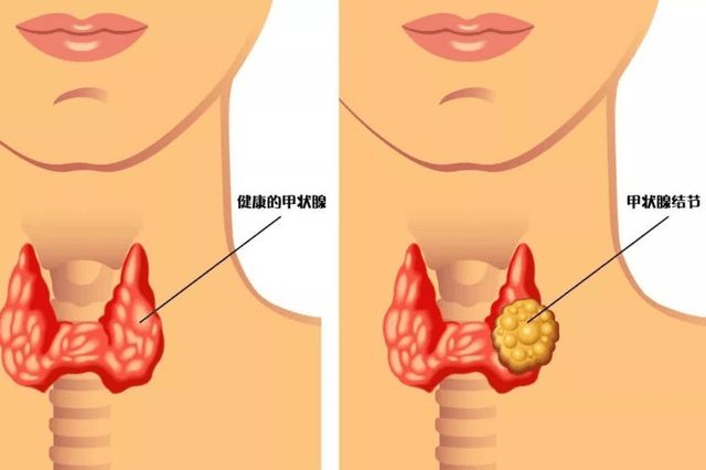 补硒预防甲状腺结节吗