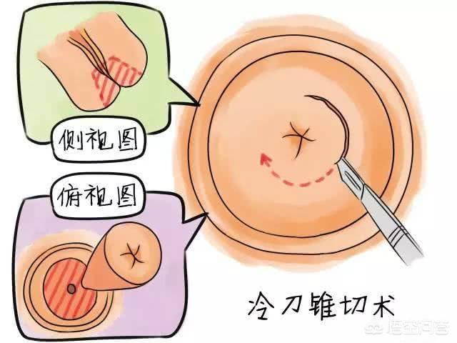 感染hpv52，该怎么办？插图7