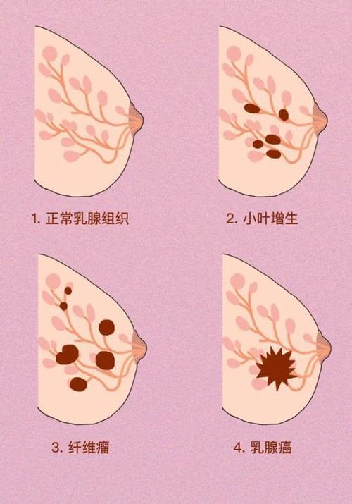 乳腺小叶增生怎么补硒