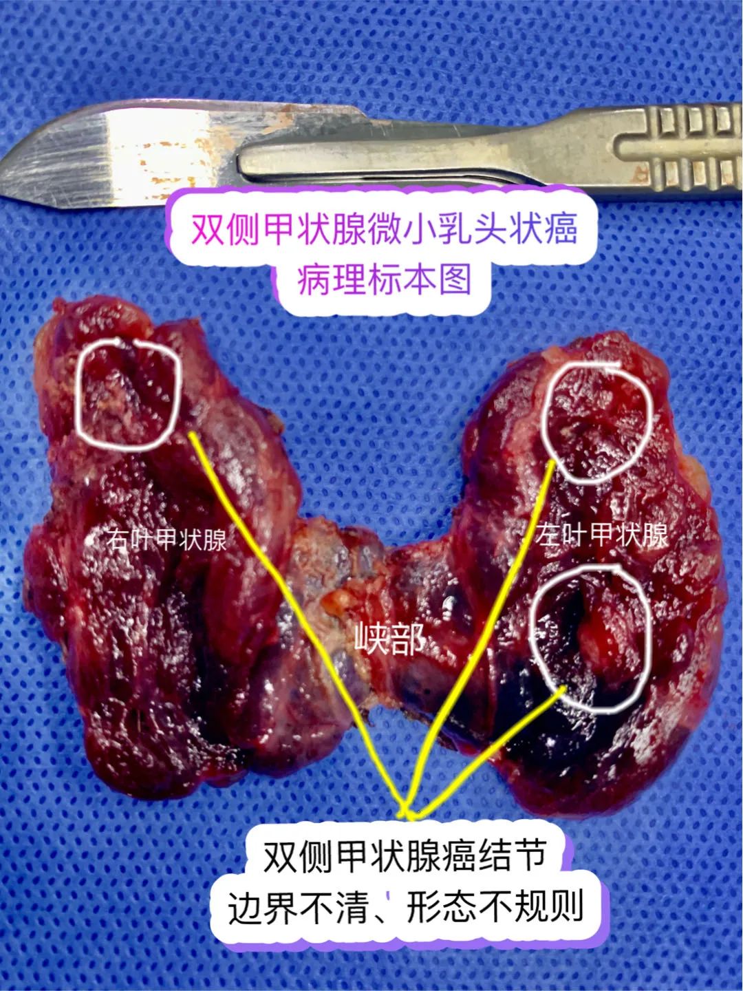 甲状腺结节补硒能好吗