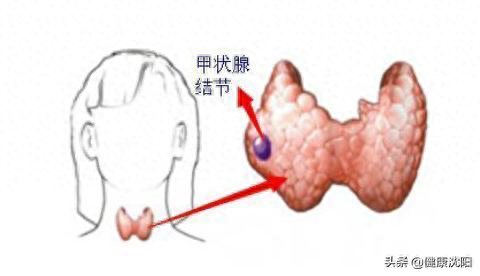 补硒对甲状腺结节有效