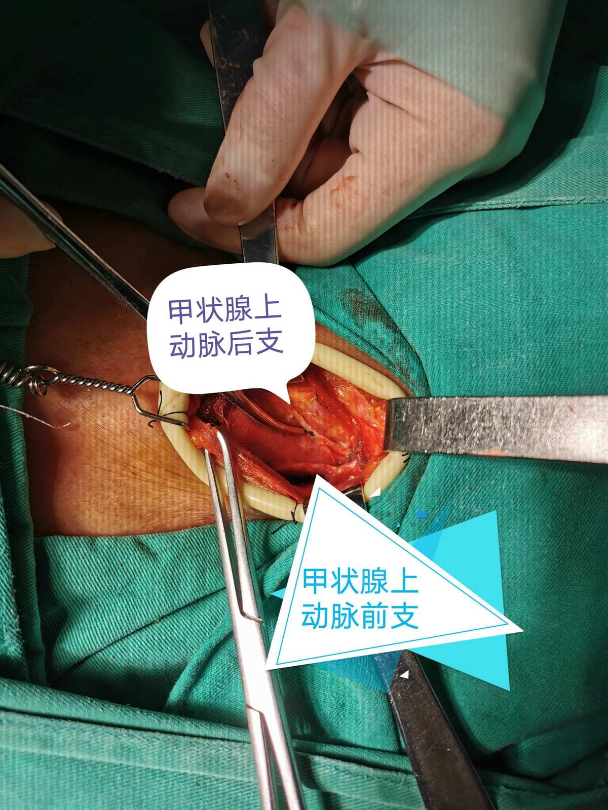 甲状腺癌术后怎么补硒