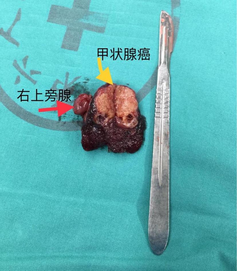 甲状腺癌术后怎么补硒