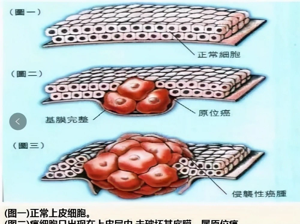 原位癌术后需要补硒吗