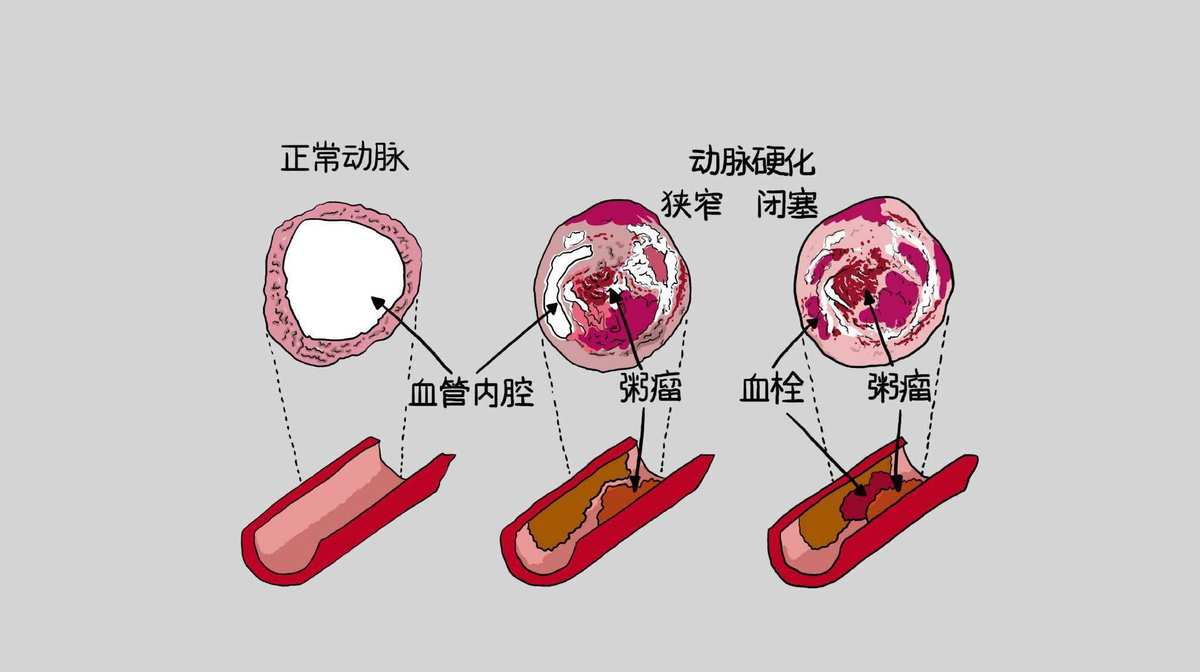 血脂异常还可以补硒吗