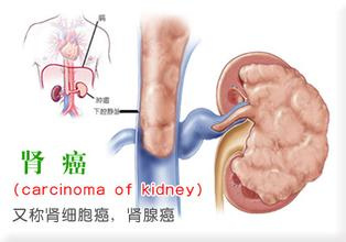 补硒能控制肾癌扩散吗