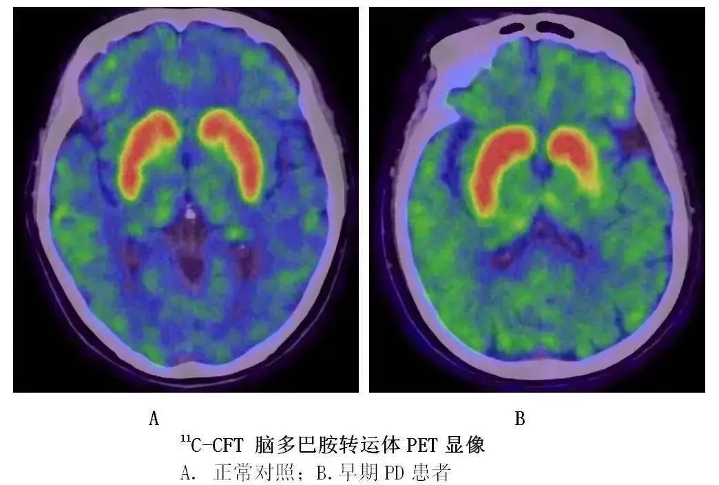 帕金森类似病可补硒吗