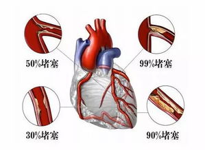 心脏支架40天支架稳定了吗，心脏支架后必须要吃的哪些药