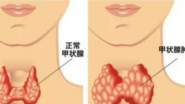 甲状腺切除后能补硒吗