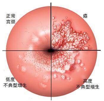 23岁女孩腰腹疼痛难忍查出癌症,医生说跟她经期总做一件事有关