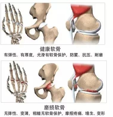 全面详细介绍骨关节疾病的症状、病因、治疗等情况，看这篇就够了