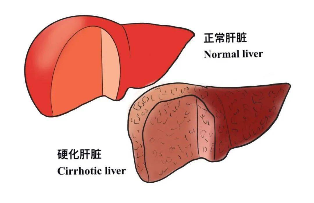 乙肝病人如何合理补硒