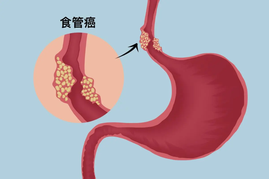 宫颈癌患者补硒的方法