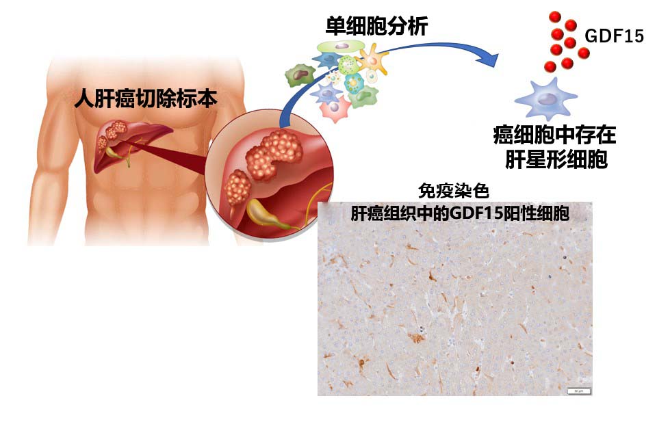 患了肝癌补硒还有用吗