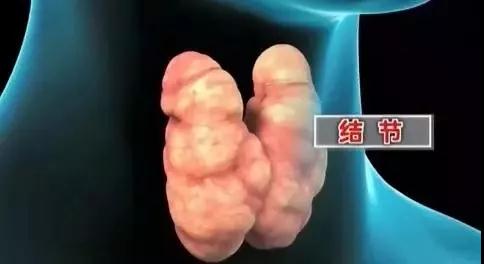 甲状腺疾病高发，到底该如何防治？这次专家终于讲清楚了……