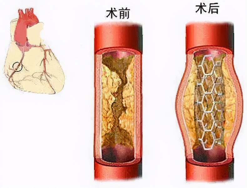 过度补硒后果