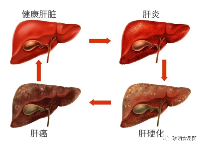 肝病要补硒吗