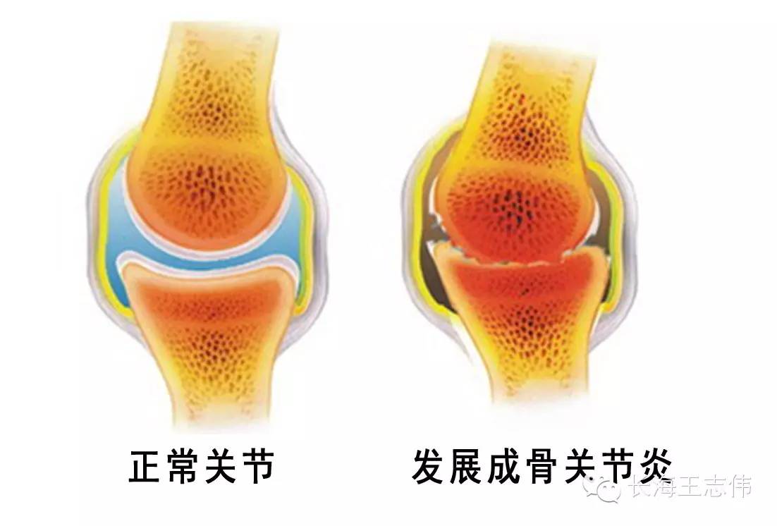 大骨节病补硒