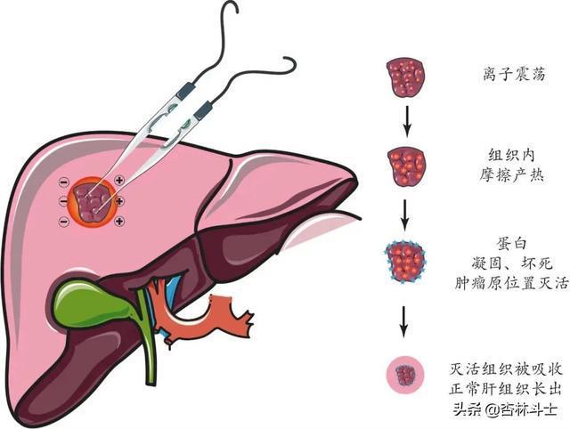 补硒睡觉手麻