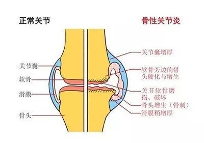 补硒与关节痛