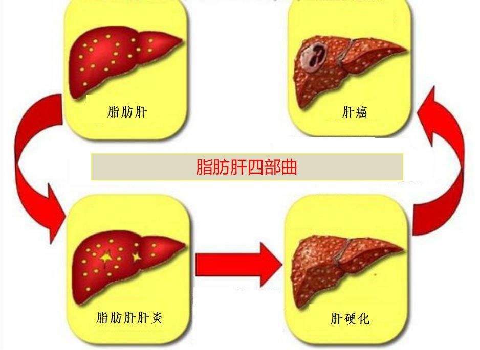 脂肪肝的食疗 脂肪肝的最佳治疗方法