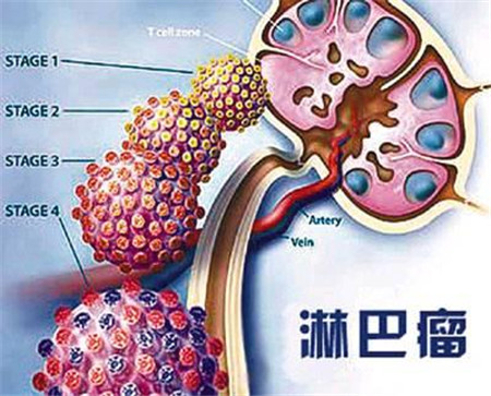 淋巴瘤补硒吗