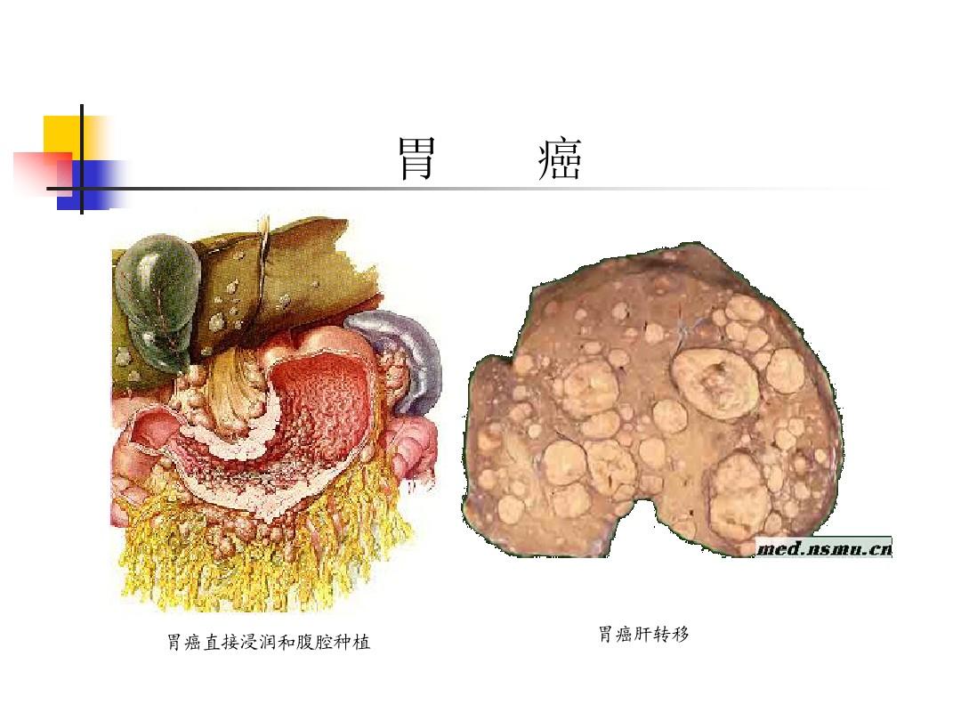 补硒和食管癌