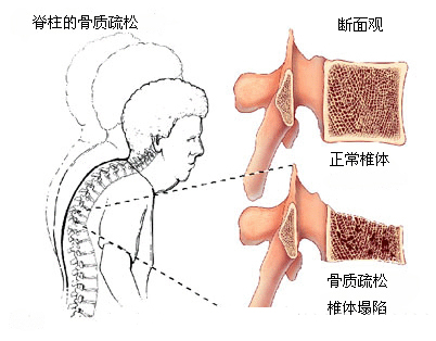 大骨头汤补钙吗