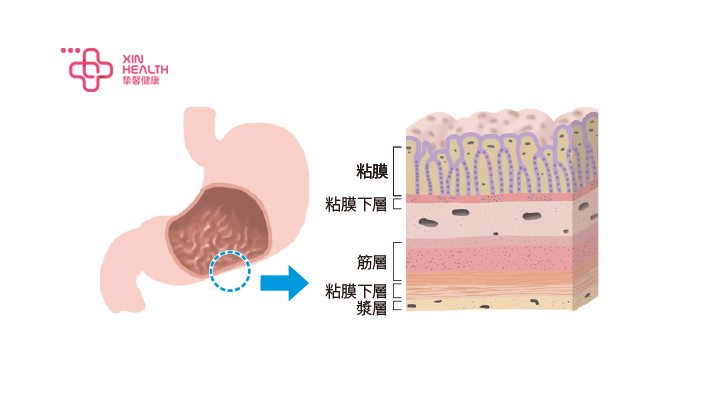 胃癌晚期 补硒