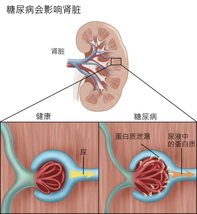 补硒防治痛风吗