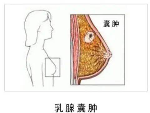 补硒与乳腺增生