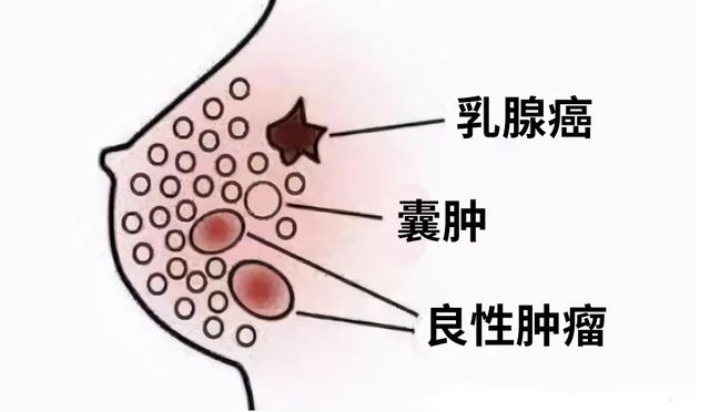 补硒与乳腺增生