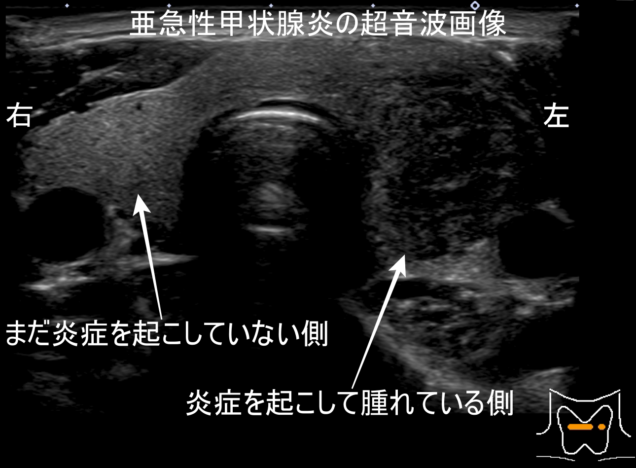 亜急性甲状腺炎