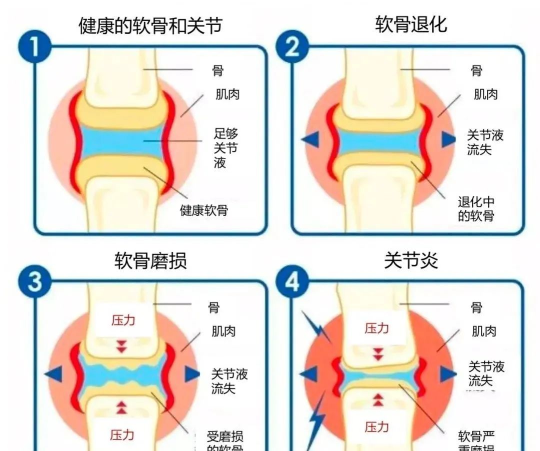 痛风能吃钙片补钙吗