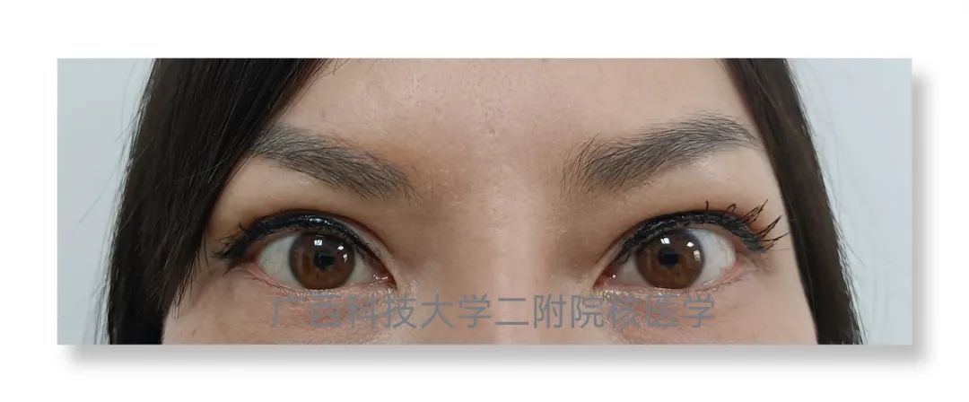 甲亢突眼 补硒