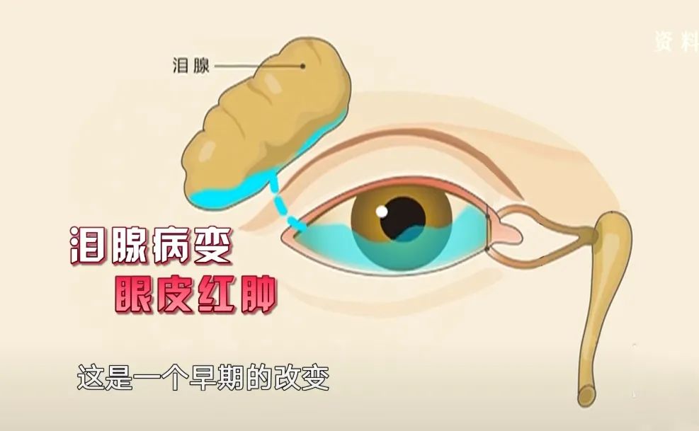 甲亢突眼 补硒