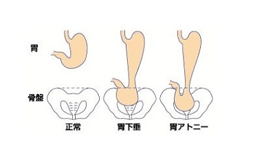 胃下垂补硒治疗