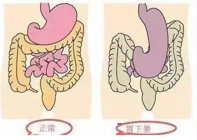 胃下垂补硒治疗