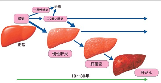 肝硬化补硒多少