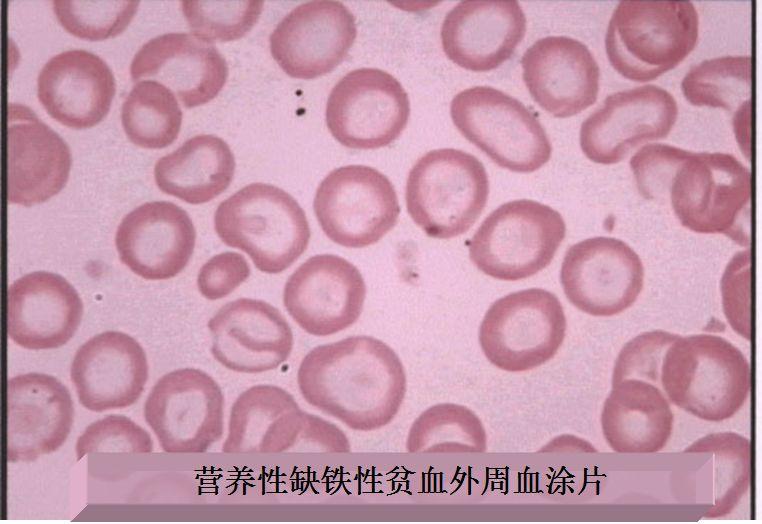 补铁是什么意思