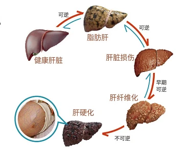 脂肪肝怎么补硒