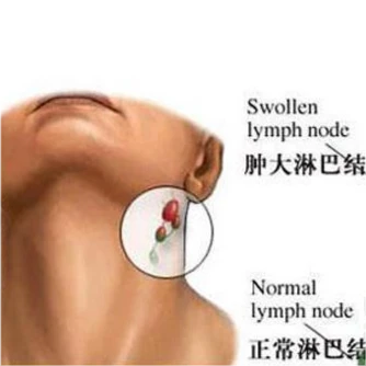 淋巴癌补硒治疗