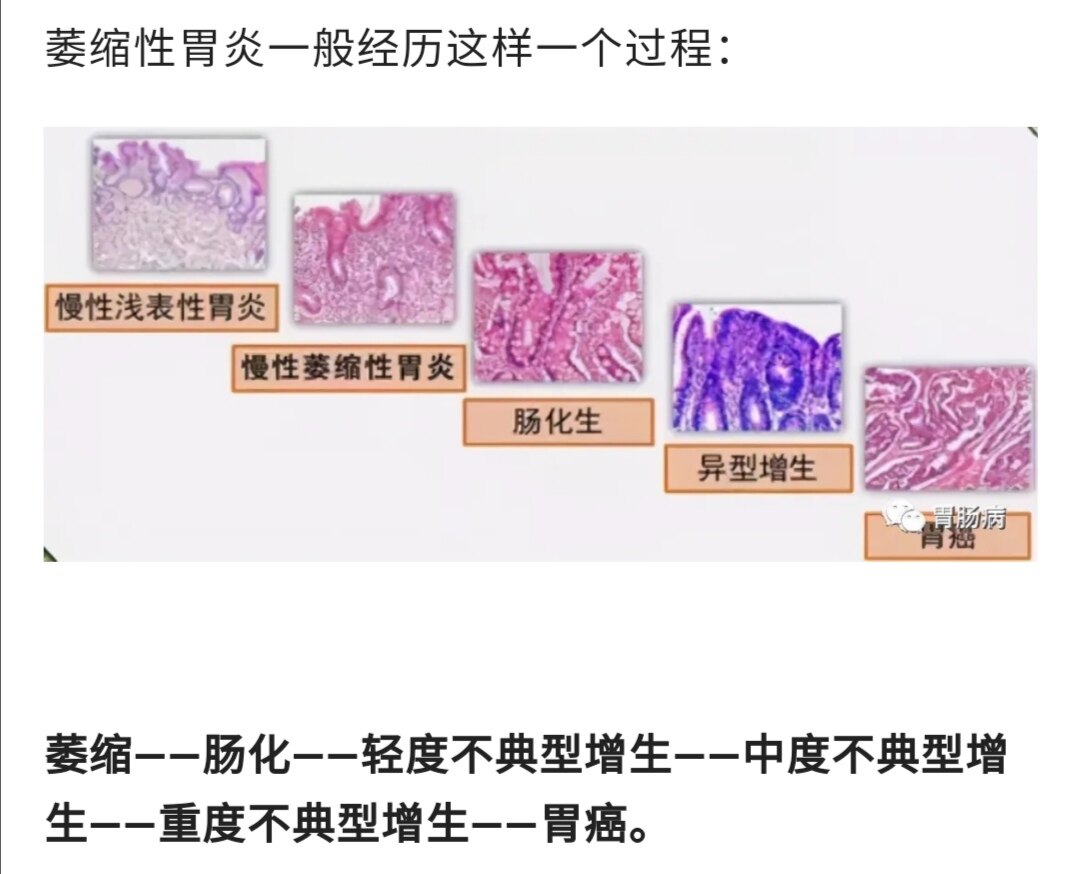 浅表性胃炎补硒