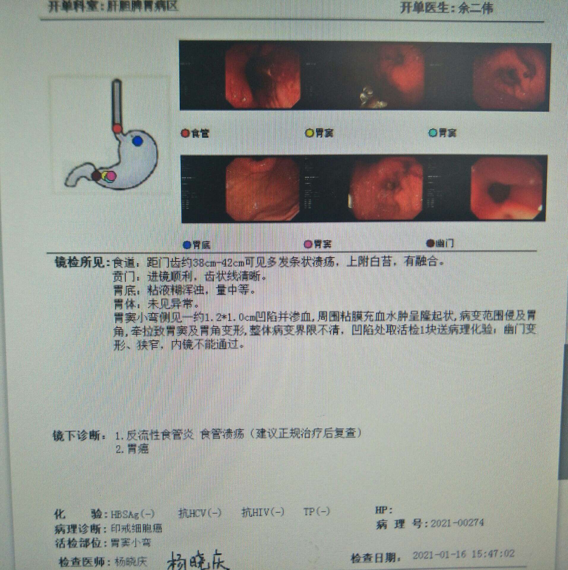 浅表性胃炎补硒