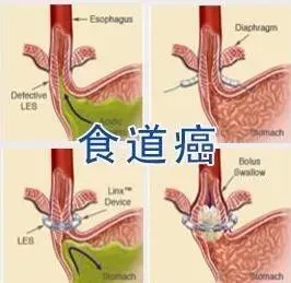 食道癌如何补硒